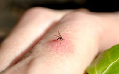 How to Treat a Mosquito Bite