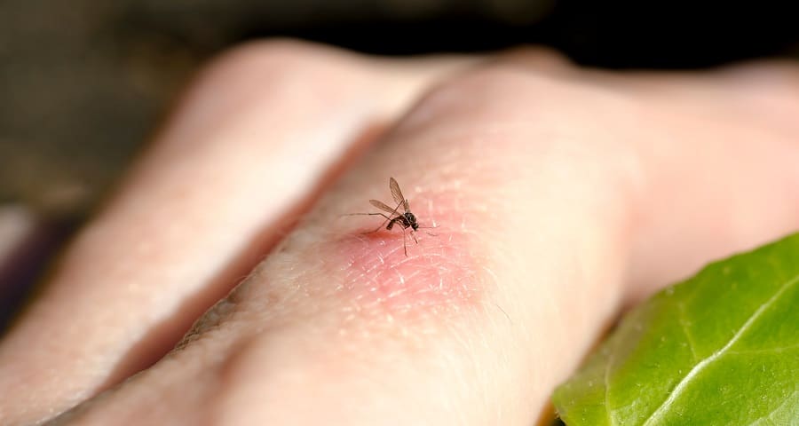 mosquito bites
